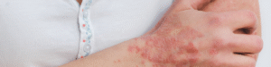 Fibromialgia e pele sensível