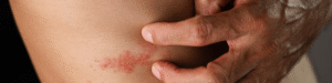 fibromialgia e pele sensível