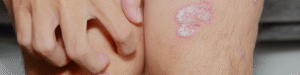 Fibromialgia
