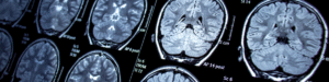 Ressonância magnética epilepsia